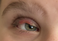 Ligneous Conjunctivitis